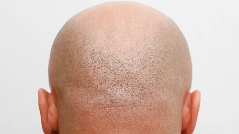 Klinik deneyler olumlu: 30 yılın ardından kellik tedavisinde ilk yeni etki mekanizması!