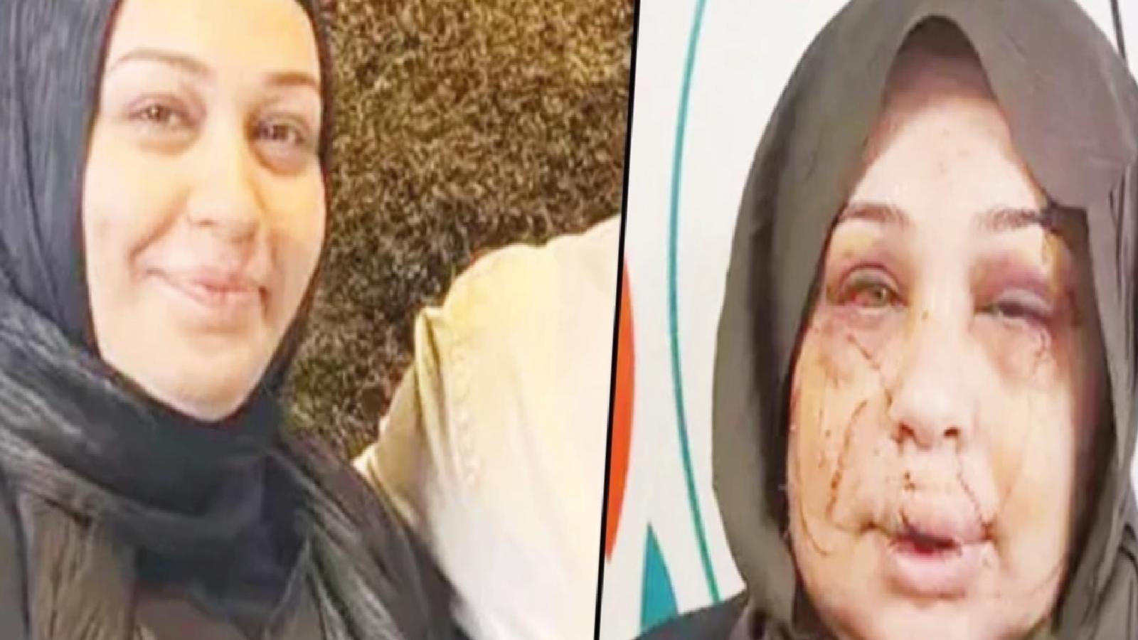 Evli olduğu kadına şiddet uygulayan Cumhurbaşkanı Koruma Dairesi personeli Çakmak’ın ifadesi: Arbedede tırnak makasıyla yaralandı