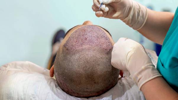 Başarısız saç ekimine 4 milyon liralık dava