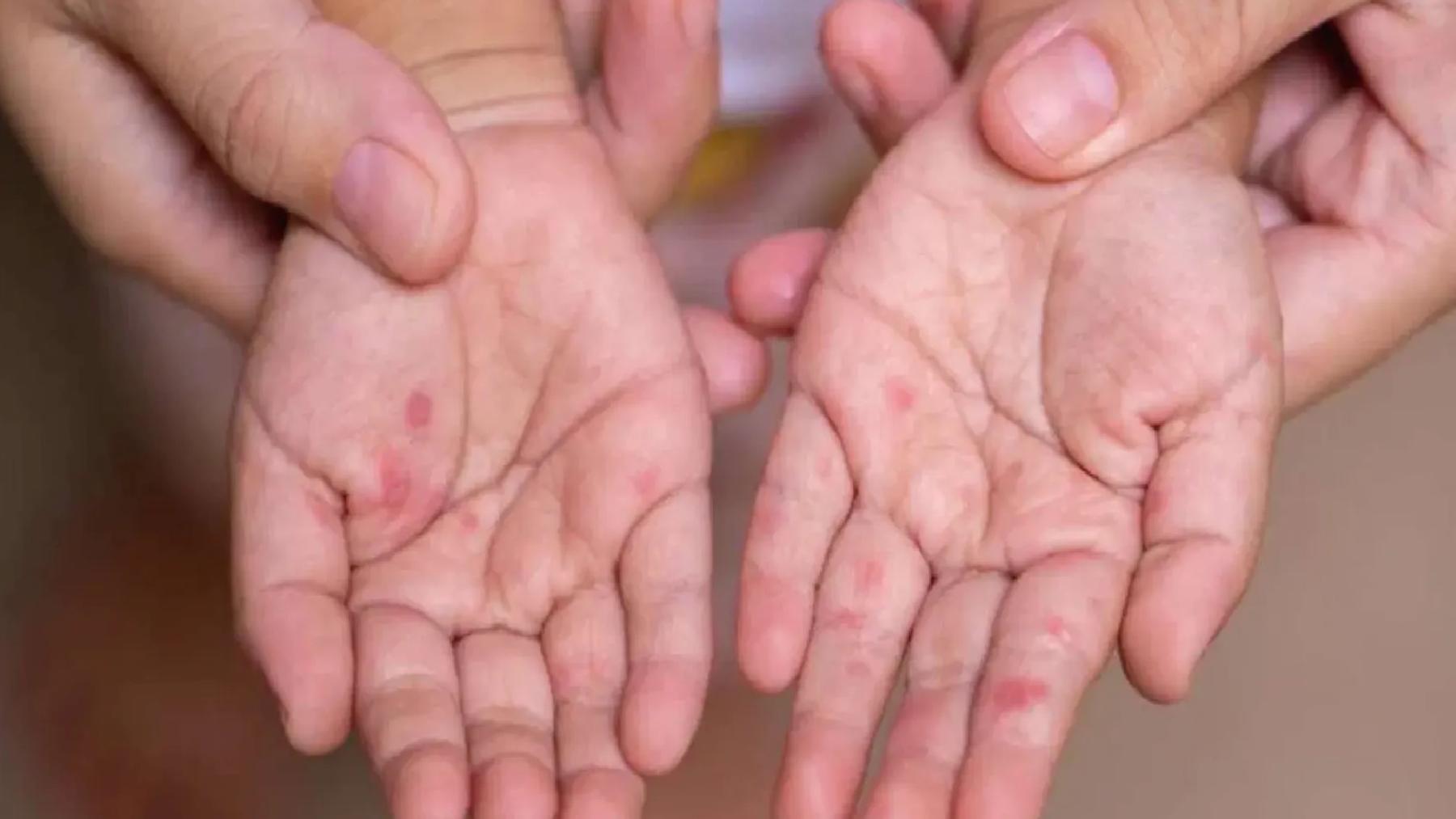 Uzmanı uyardı: Aşılanma oranlarındaki düşüş bulaşıcı hastalıkların artışına sebep oluyor!