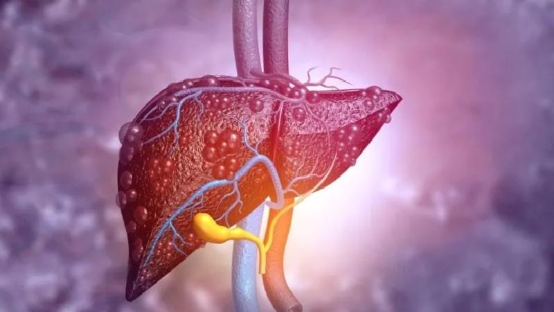 Uzmanlar uyarıyor: 2050 yılına kadar 1,8 milyar insanı etkileyecek karaciğer hastalığı!