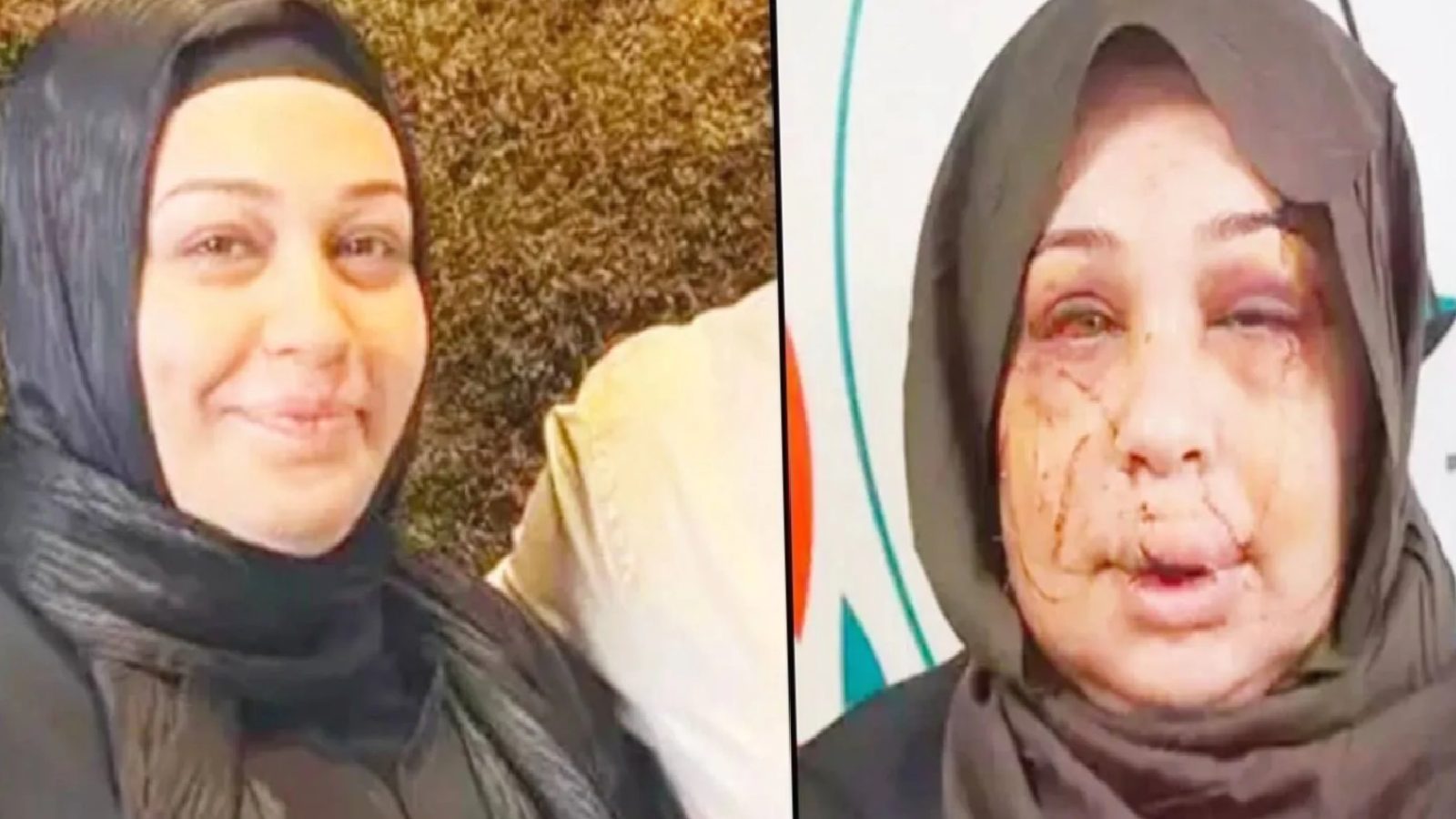 Boşanmak isteyen eşinin tırnak makasıyla yüzünü kesen Cumhurbaşkanı Koruma Dairesi personeline iyi hal indirimi; sadece 4 yıl 2 ay ceza aldı!
